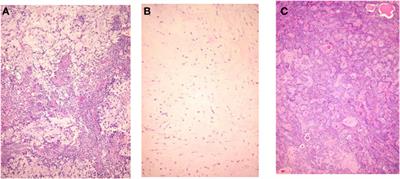 Why Do Parotid Pleomorphic Adenomas Recur? A Systematic Review of Pathological and Surgical Variables